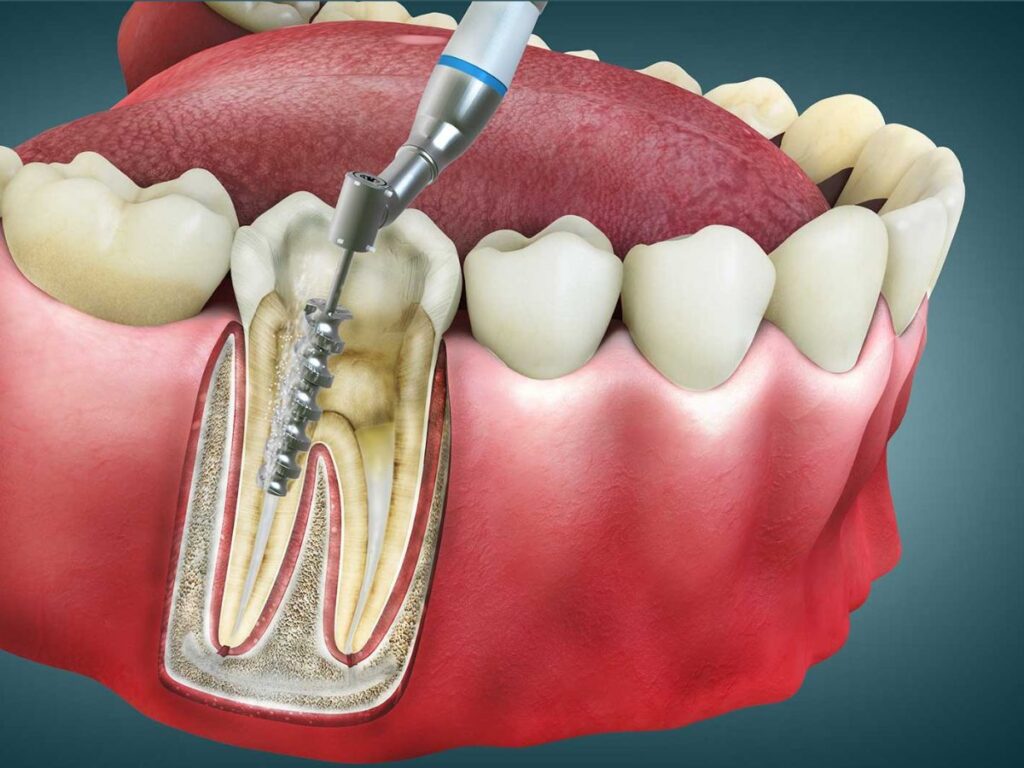 Root Canal