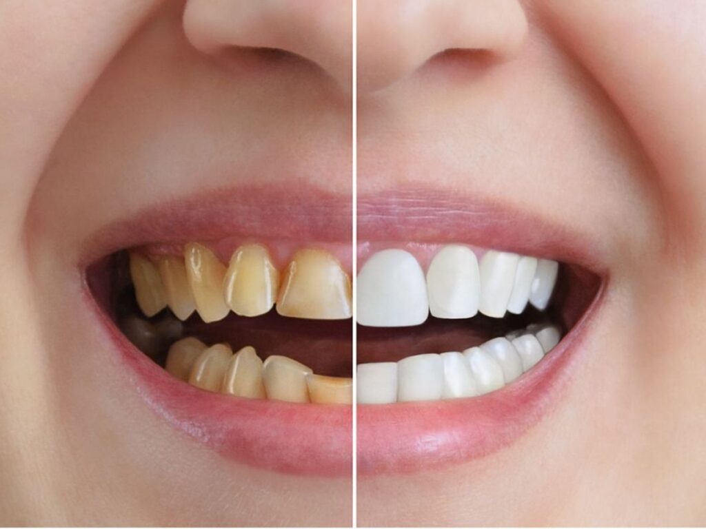 Teeth Whitening